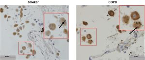 Pictures showing lung cells under the microscope. In one we see small carbon particles in the cells of smokers and in the other we see big particles in the cells of COPD patients